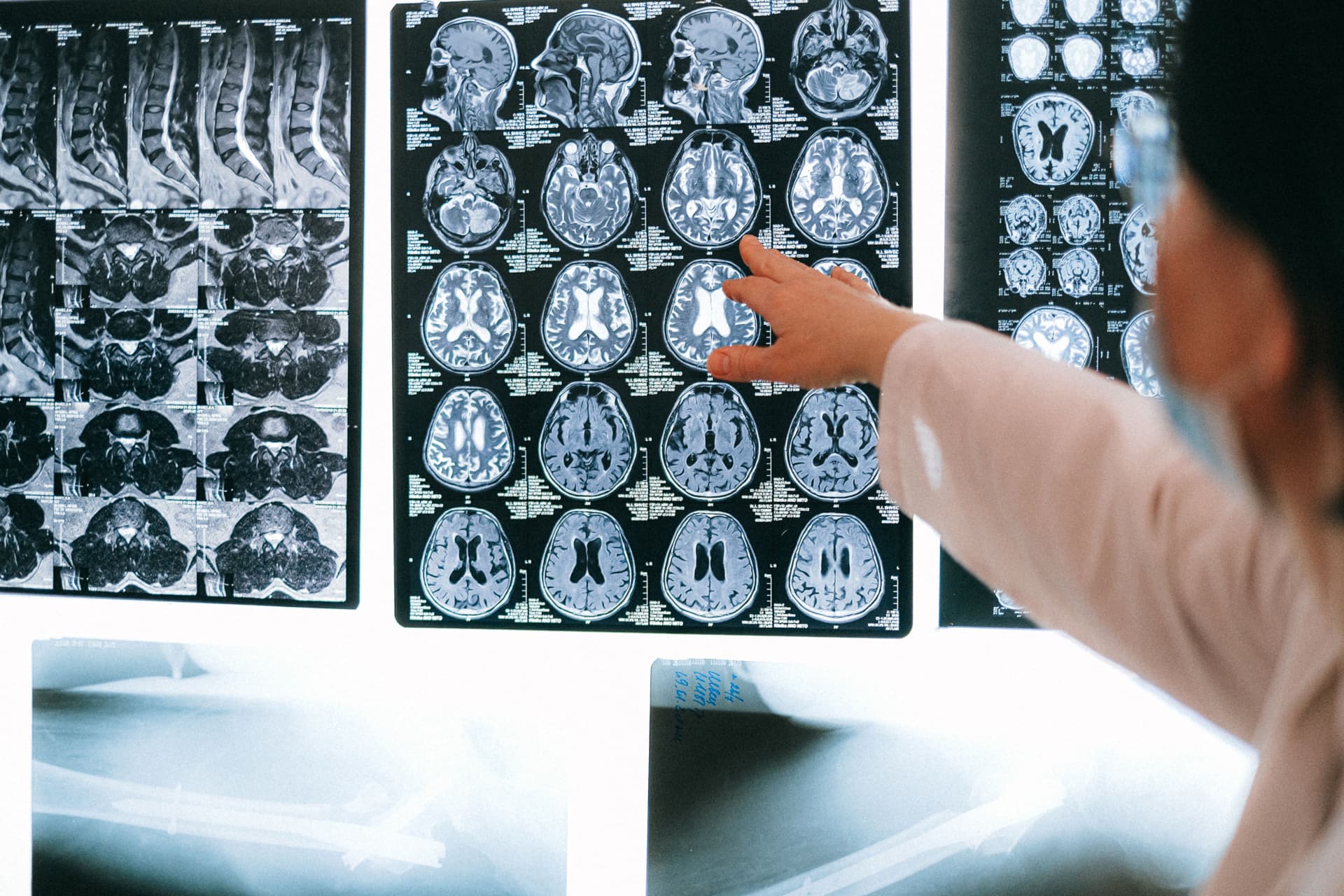 Medical professional reviewing brain MRI scans on a clinical lightbox